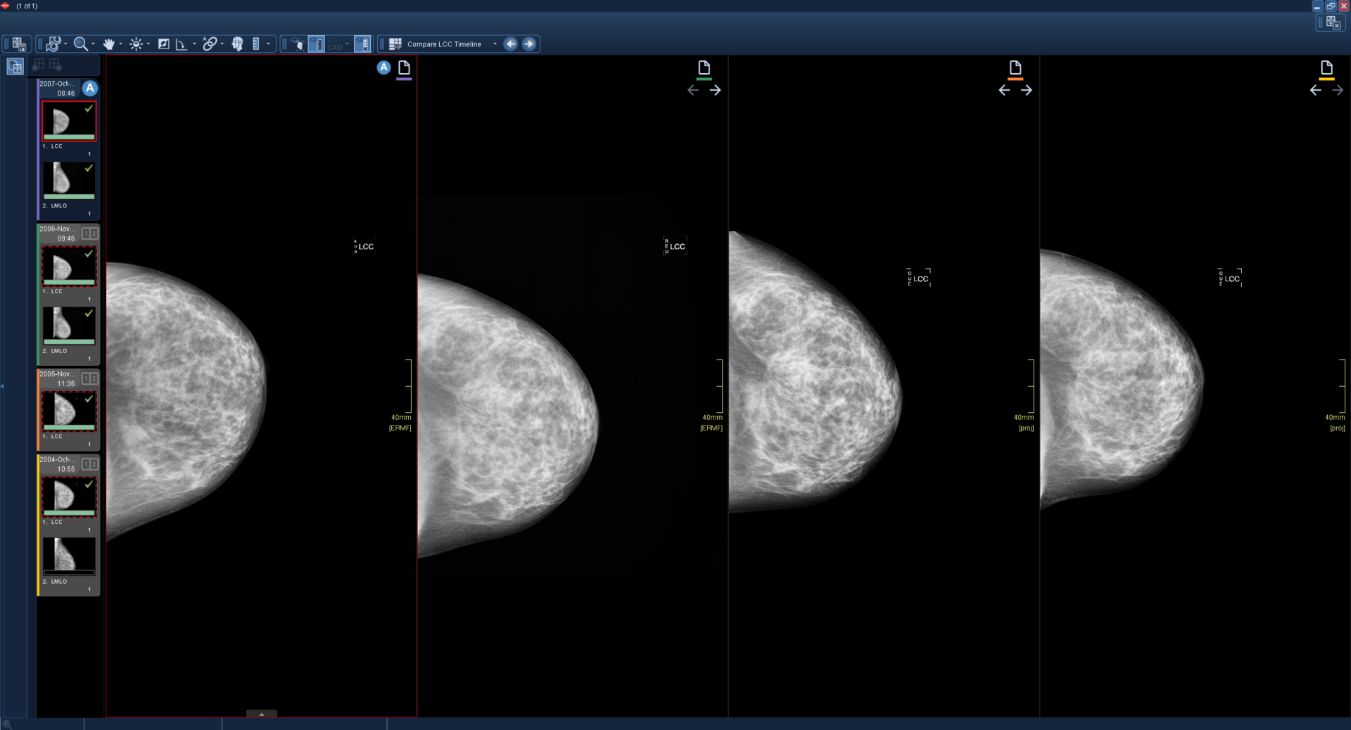 Εμφανίζονται τέσσερα παράθυρα και όλα περιέχουν εικόνες μαστογραφίας.