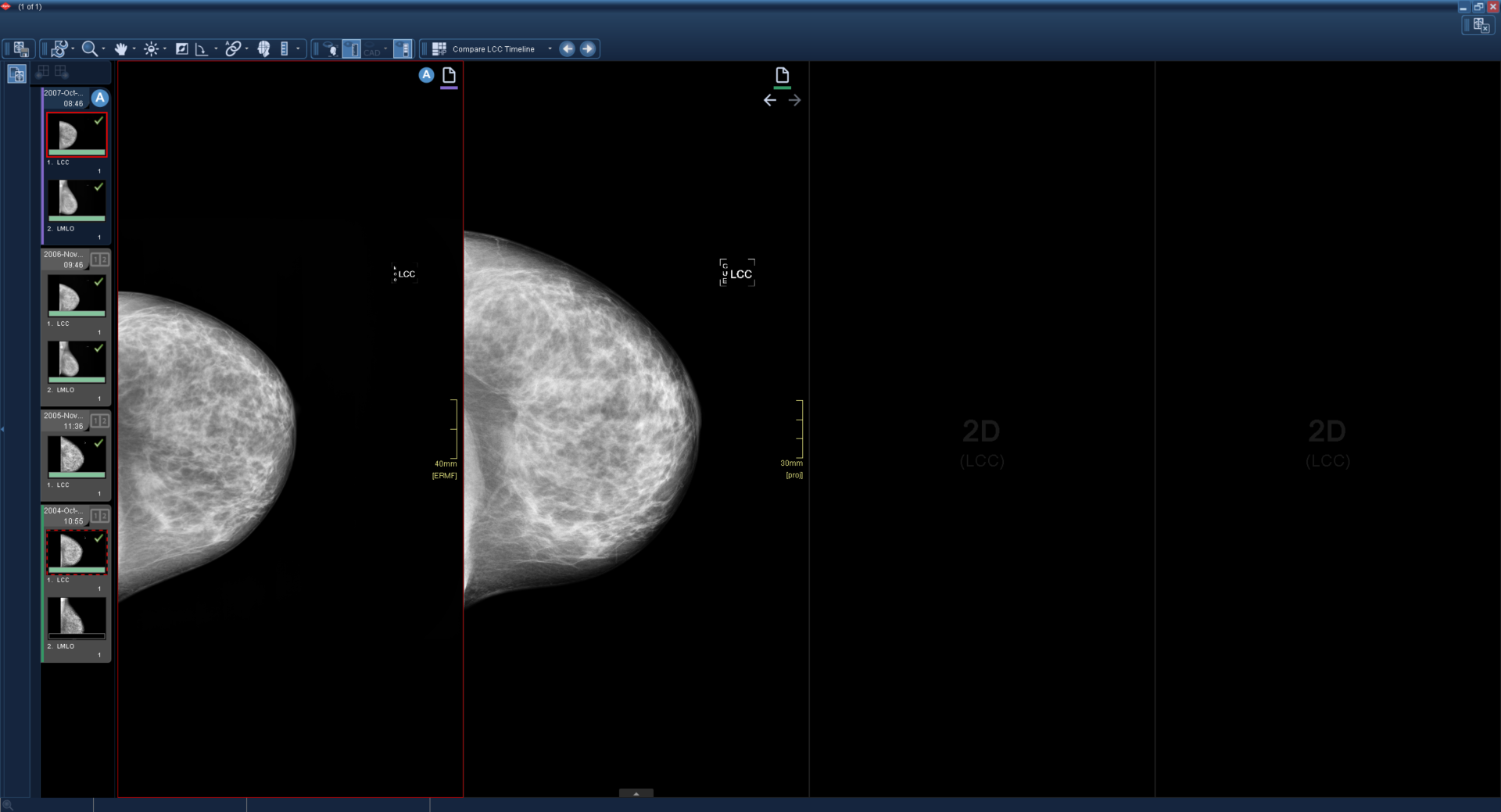 Εμφανίζονται τέσσερα παράθυρα. Τα δύο περιέχουν εικόνες μαστογραφίας και τα άλλα δύο είναι μαύρα.