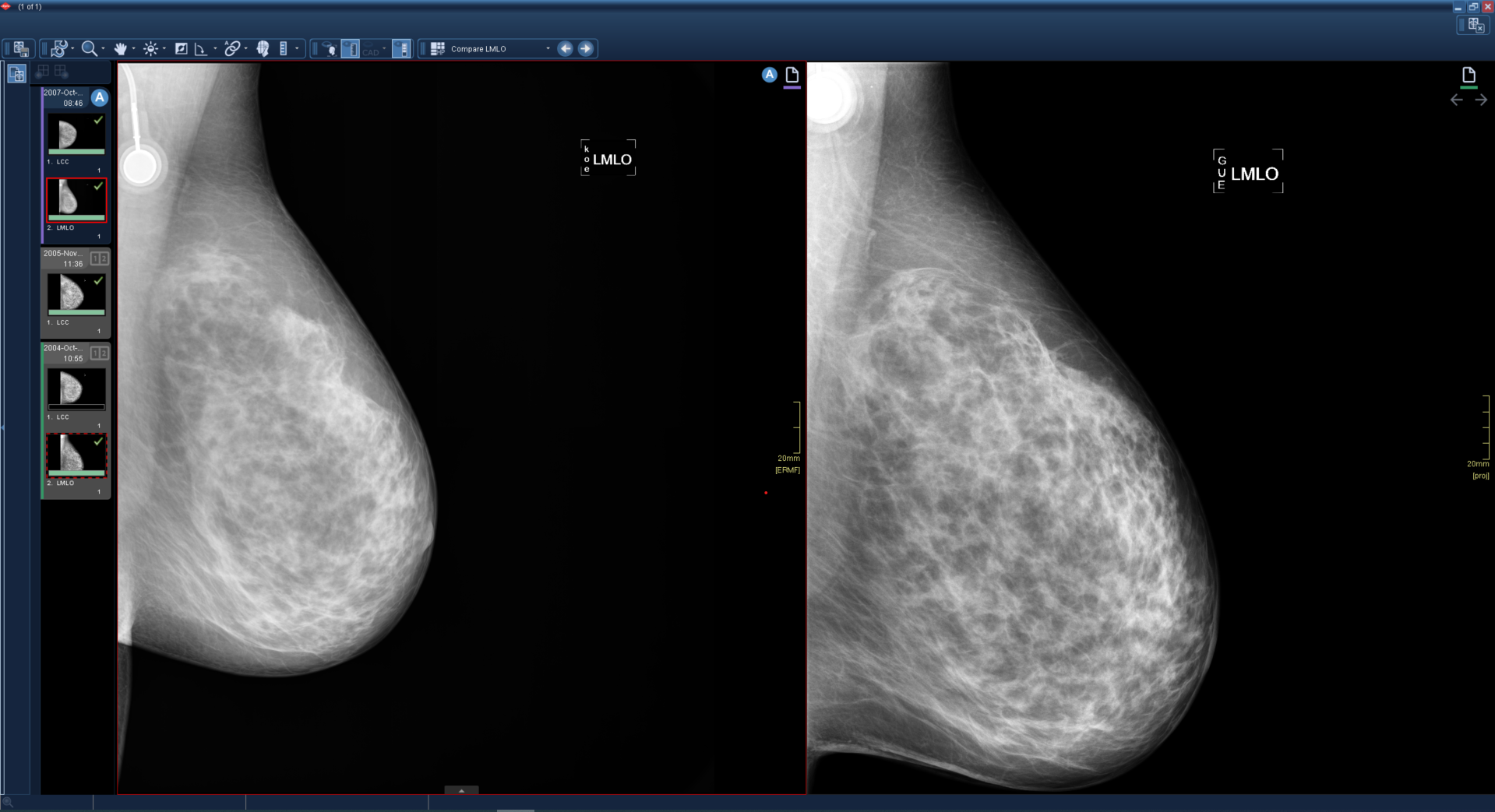 Εμφανίζονται δύο παράθυρα εκ των οποίων και τα δύο περιέχουν εικόνες μαστογραφίας.