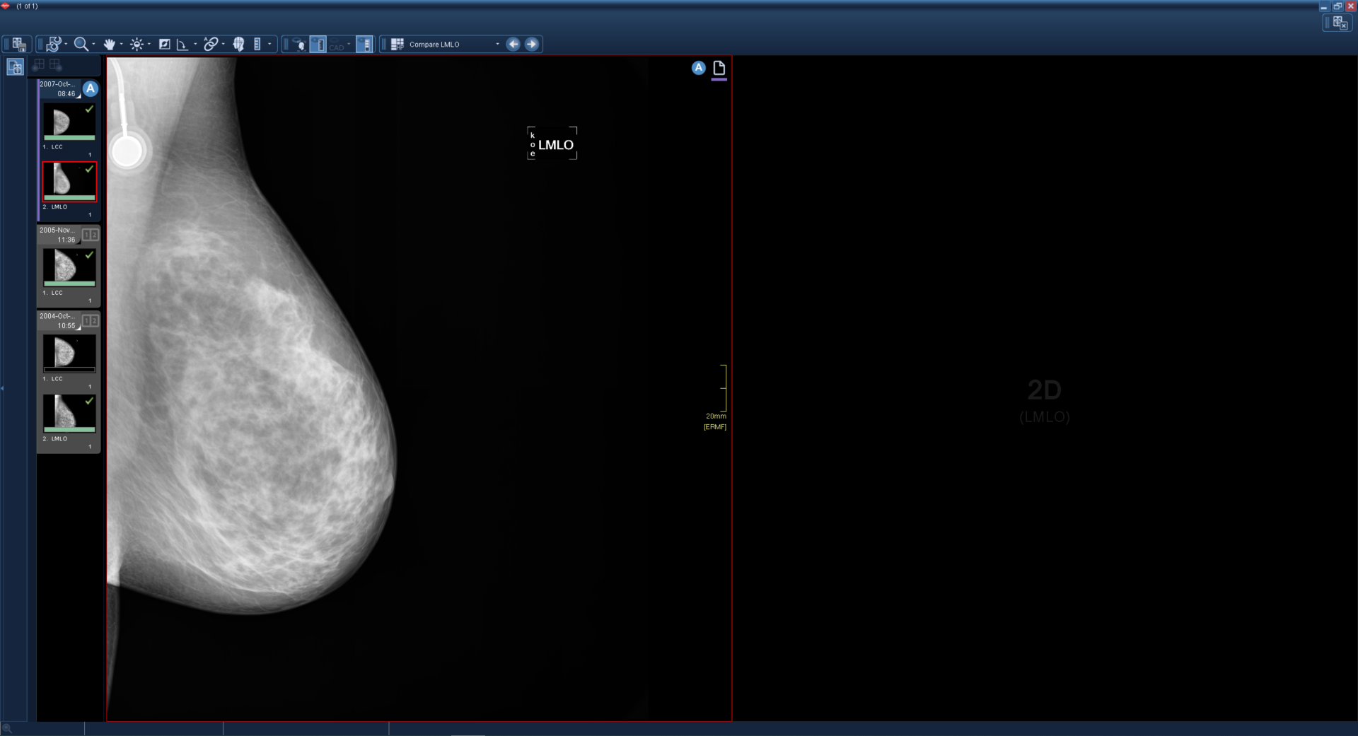 Εμφανίζονται δύο παράθυρα. Το ένα περιέχει μια εικόνα μαστογραφίας και το άλλο είναι μαύρο.