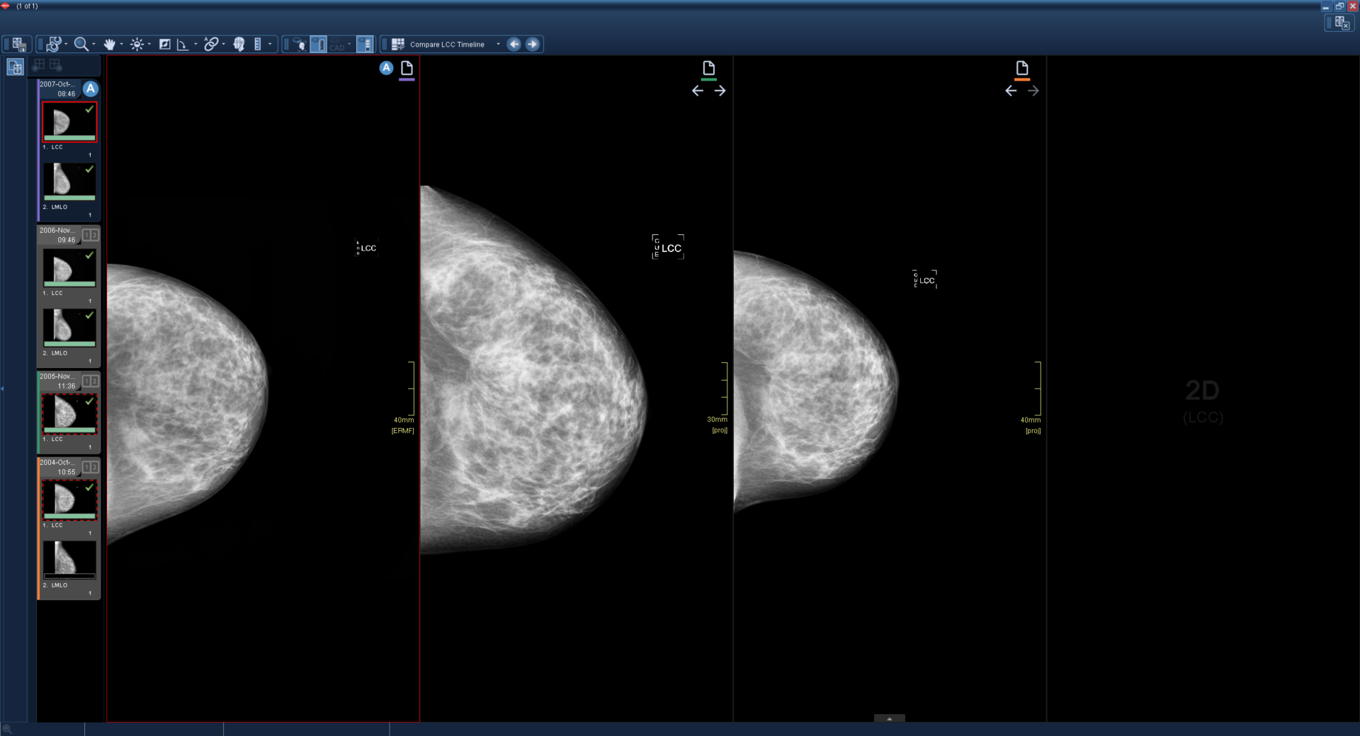 Εμφανίζονται τέσσερα παράθυρα. Τρία περιέχουν εικόνες μαστογραφίας και ένα είναι μαύρο.