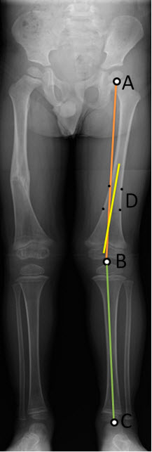 Διάγραμμα γραμμών μέτρησης ισχίου-γόνατου-αστραγάλου