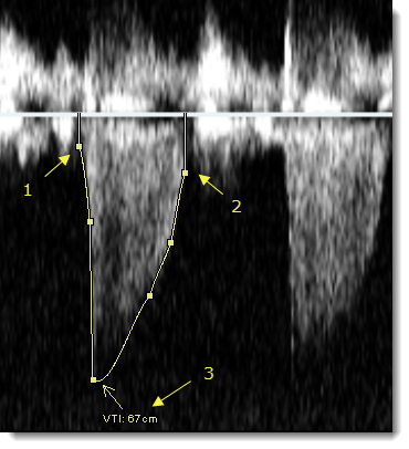 Εικόνα που δείχνει την αρχική (1), την τελική (2) και την οριστική μέτρηση