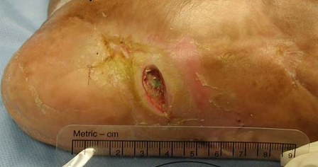 Φωτογραφία που απεικονίζει μια πληγή που έχει φωτογραφηθεί με κανόνα για τη διευκόλυνση της βαθμονόμησης