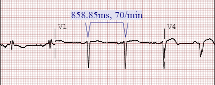 Εξέταση ΗΚΓ με το εργαλείο R2R