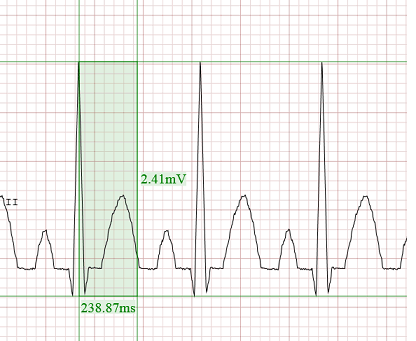 Εξέταση ΗΚΓ με εργαλείο μέτρησης