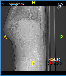 Εικόνα που δείχνει τους εξής δείκτες προσανατολισμού: anterior (A) (πρόσθιος), posterior (P) (οπίσθιος), head (H) (κεφαλή) και foot (F) (πόδι)